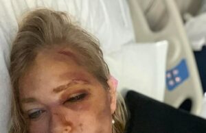 Virgínia Virgina Giuffre compartilhou uma selfie de sua cama de hospital mostrando seu rosto severamente machucado, mas o motorista do ônibus, a polícia de WA e várias outras testemunhas disseram que a colisão não era tão séria quanto ela.