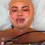 Chrissy Teigen compartilhou uma foto muito alarmante de suas histórias de Insta na quinta -feira. O modelo de trajes de banho Sports Illustrated foi visto por um curativo bege debaixo do queixo, em volta das bochechas e em cima da cabeça quando ela foi