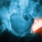 Mudanças no mercado de implantes ortopédicos na Polônia: Medtech Solutions com desconto em implantes médicos do GPC