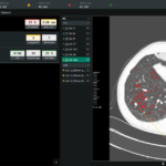 O câncer de pulmão macio de Coreline é adicionado à Bayer Calantic.