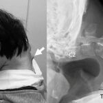 Fotografias chocantes mostram que seu pescoço explodiu por seus médicos que suas vértebras se tornaram