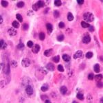 Endonoses car-t-terapia potencialmente curar em mieloma múltiplo