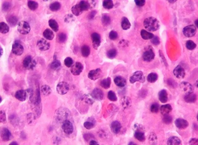 Endonoses car-t-terapia potencialmente curar em mieloma múltiplo
