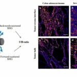 As diferenças raciais na estrutura do colágeno do tumor podem afetar a previsão do câncer