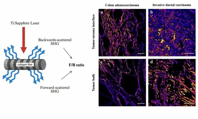 As diferenças raciais na estrutura do colágeno do tumor podem afetar a previsão do câncer