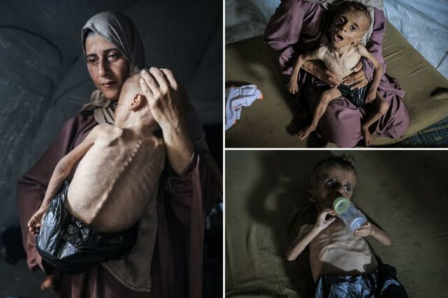 As imagens virais do garoto faminto não contam a história toda porque ele sofre de distúrbios genéticos, como dizem os críticos

