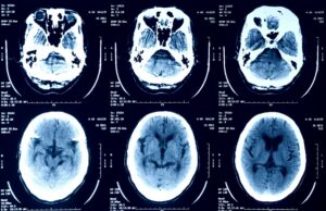 Episource informa milhões de pessoas que seus dados de saúde foram roubados a selection of X-ray scans of a human head