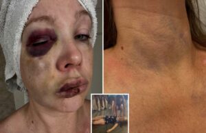 Fotos macabras mostram o rosto de uma mulher seriamente danificada durante a terrível luta de Cincinnati Fotos macabras mostram o rosto de uma mulher seriamente danificada durante a terrível luta de Cincinnati