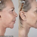 Leslie Ash, 65 anos, se abriu para fazer um facelift não cirúrgico de £ 4500 que a fez ver