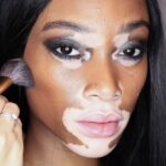 Não é uma doença infecciosa! O estresse severo pode realmente acelerar a propagação de vitiligo