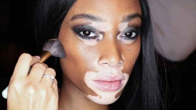 Não é uma doença infecciosa! O estresse severo pode realmente acelerar a propagação de vitiligo

