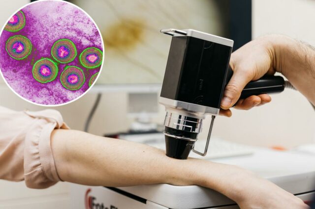 Os médicos criaram uma maneira de usar o herpes para combater o câncer avançado de curta duração

