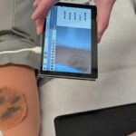 Os pesquisadores utilizam a IA para converter o diagnóstico de câncer de pele em áreas remotas