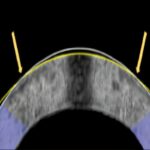 Uma alternativa a Lasik - sem os lasers
