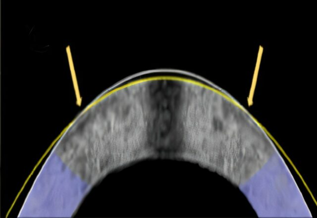 Uma alternativa a Lasik - sem os lasers