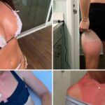 As queimaduras solares da estrela presumem que ... deita a (vitamina) D!