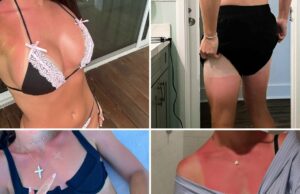 As queimaduras solares da estrela presumem que … deita a (vitamina) D! As queimaduras solares da estrela presumem que ... deita a (vitamina) D!