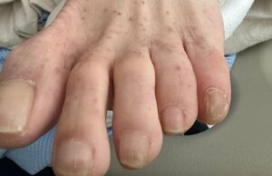 Doença manchada de montanha rochosa se espalha no Canadá Pé com erupção cutânea irregular