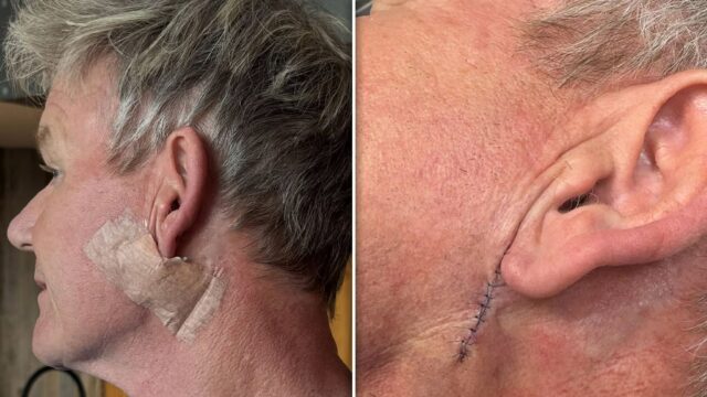 Gordon Ramsay Skin Cancer Instagram 3