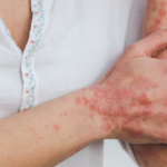 Mês da psoríase mundial: os dermatologistas compartilham dicas sobre como gerenciá -lo.