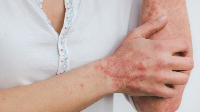 Mês da psoríase mundial: os dermatologistas compartilham dicas sobre como gerenciá -lo.



