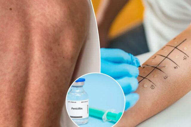 Muitos americanos acham que têm uma alergia - mas apenas 1% realmente fazem

