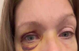 Mulher de Cincinnati que é abusada de uma missa na luta de rua revela que ficou com o trauma cerebral A mulher, conhecida apenas como Holly, foi identificada pelos legisladores da cidade no início desta semana após o incidente no fim de semana passado que se tornou viral