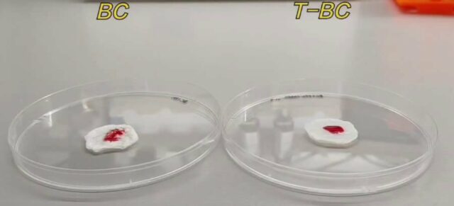 Os pesquisadores desenvolvem juntas bacterianas à base de celulose para queimaduras avançadas