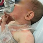 Faz quase um ano que o bebê Luka tomou café quente derramado por um estranho