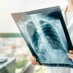 14 Computador de índios com 45 anos ou mais pode ter doenças pulmonares obstrutivas: estudo de pesquisa