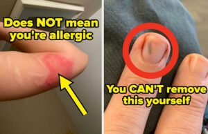 16 Saúde e bem -estar “existe” os indivíduos ainda acreditam (no entanto, na verdade, não deveria), de acordo com profissionais médicos e enfermeiros registrados A reação alérgica visível na mão de uma pessoa mostra manchas vermelhas e irritadas e inchaços na pele