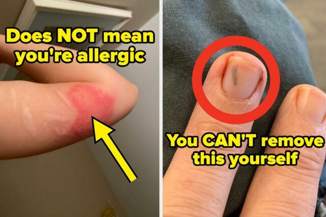 A reação alérgica visível na mão de uma pessoa mostra manchas vermelhas e irritadas e inchaços na pele