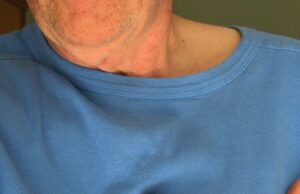 Angústia emocional usual após uma doença cardiovascular, pode causar futuras doenças cardíacas ataque cardíaco