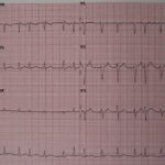 fibrilação atrial