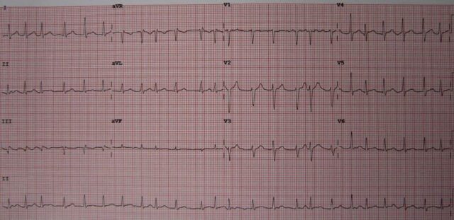 fibrilação atrial