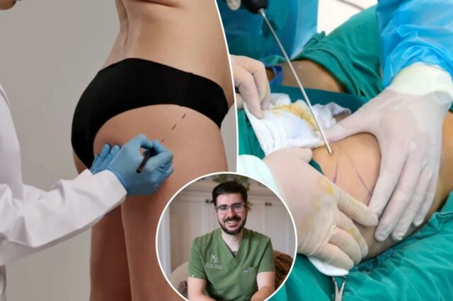Eu sou um cirurgião plástico - por que nunca realizaria um 'acordado bbl', eu ouvi histórias de horror absoluto


