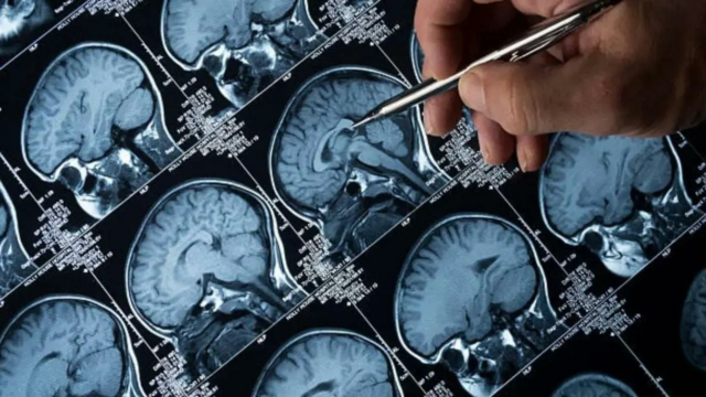 Link da web entre doenças vasculares, perigo de deterioração mental esquecida: estudo de pesquisa 

