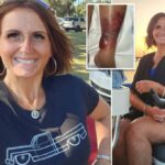 Mamãe quase perde a vida e a perna depois de contrair bactérias que comem carne durante a Florida Swim: 'A dor é inacreditável'