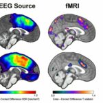 Duas varreduras cerebrais são melhores do que uma para prever a ansiedade dos adolescentes, segundo estudo