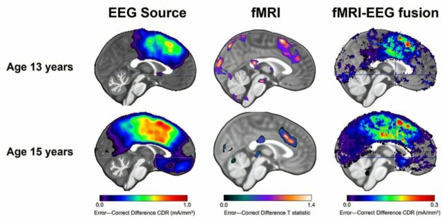 A integração de duas varreduras mentais descobre dicas ocultas sobre Duas varreduras cerebrais são melhores do que uma para prever a ansiedade dos adolescentes, segundo estudo