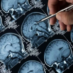 As células cancerígenas da mente fatal podem mudar de cabeça, feedback imune: estudo de pesquisa