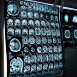 Dia Mundial do AVC 2025: Aumento dos casos de AVC entre jovens com menos de 40 anos