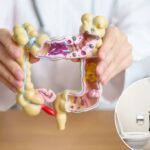 Este é o 'mais forte preditor de câncer colorretal' abaixo de 50 - aumenta suas chances em 850%