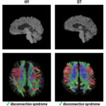 Estudo do 'cérebro dividido': apenas algumas fibras permitem a comunicação entre os dois hemisférios do cérebro