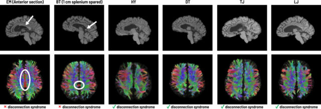 Estudo de 'cérebro dividido' descobre que apenas algumas fibras permitem Estudo do 'cérebro dividido': apenas algumas fibras permitem a comunicação entre os dois hemisférios do cérebro