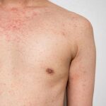 Mais de 5.000 casos de sarampo ameaçam o status de eliminação do Canadá