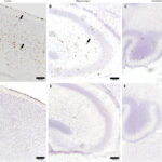 A terapia genética pode oferecer uma nova esperança para crianças com doença rara e fatal