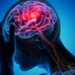 Os acidentes vasculares cerebrais são apenas uma das 5 principais razões de fatalidade na Índia, afirmam profissionais