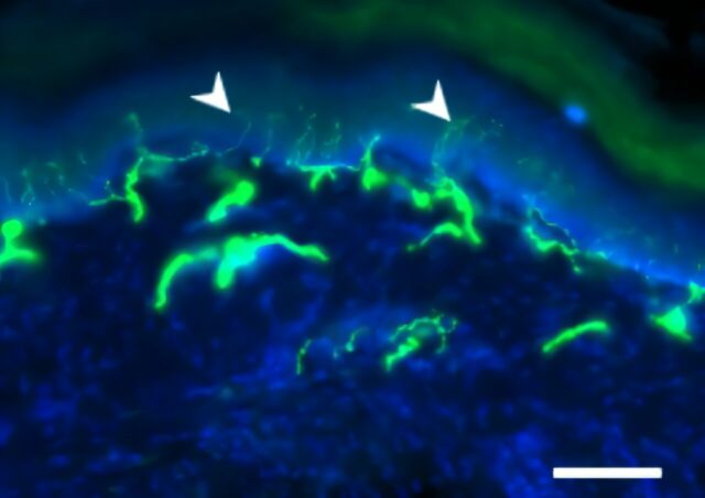 Uma molécula promissora contra neuropatias induzidas por quimioterapia Uma molécula promissora contra neuropatias induzidas por quimioterapia