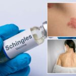 Vacina contra herpes zoster está associada a benefícios significativos à saúde, revelam especialistas